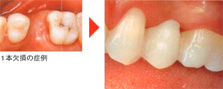 セラミッククラウン、ブリッジ……1本欠損の場合